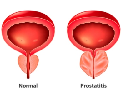prostatitis cronica