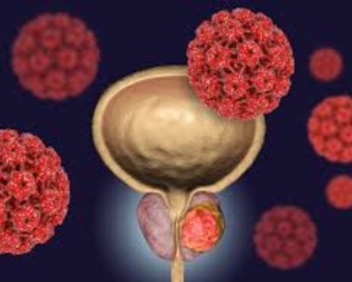 cancer de prostata